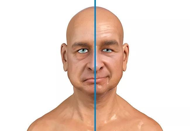 Bells Palsy