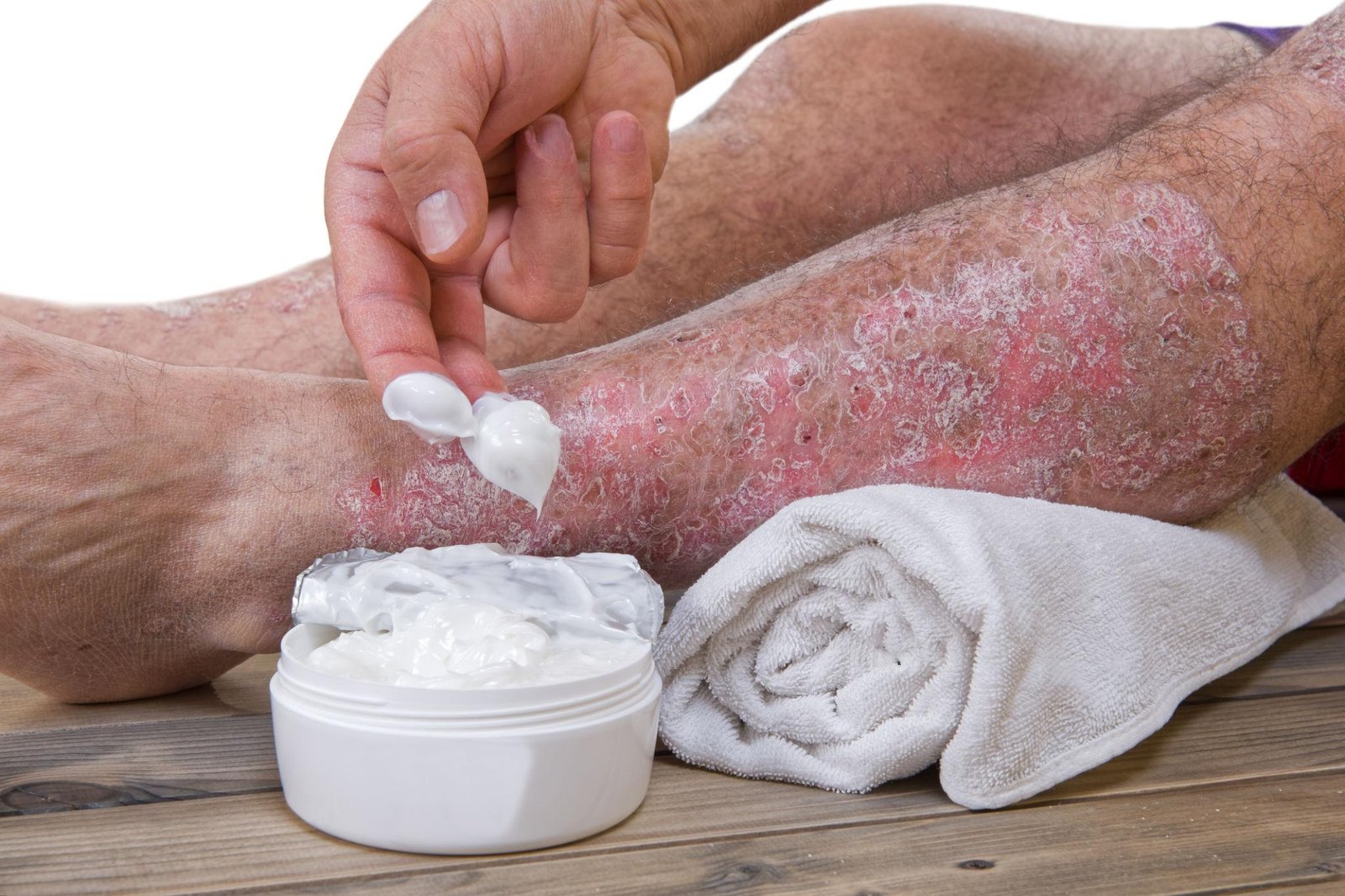Psoriasis