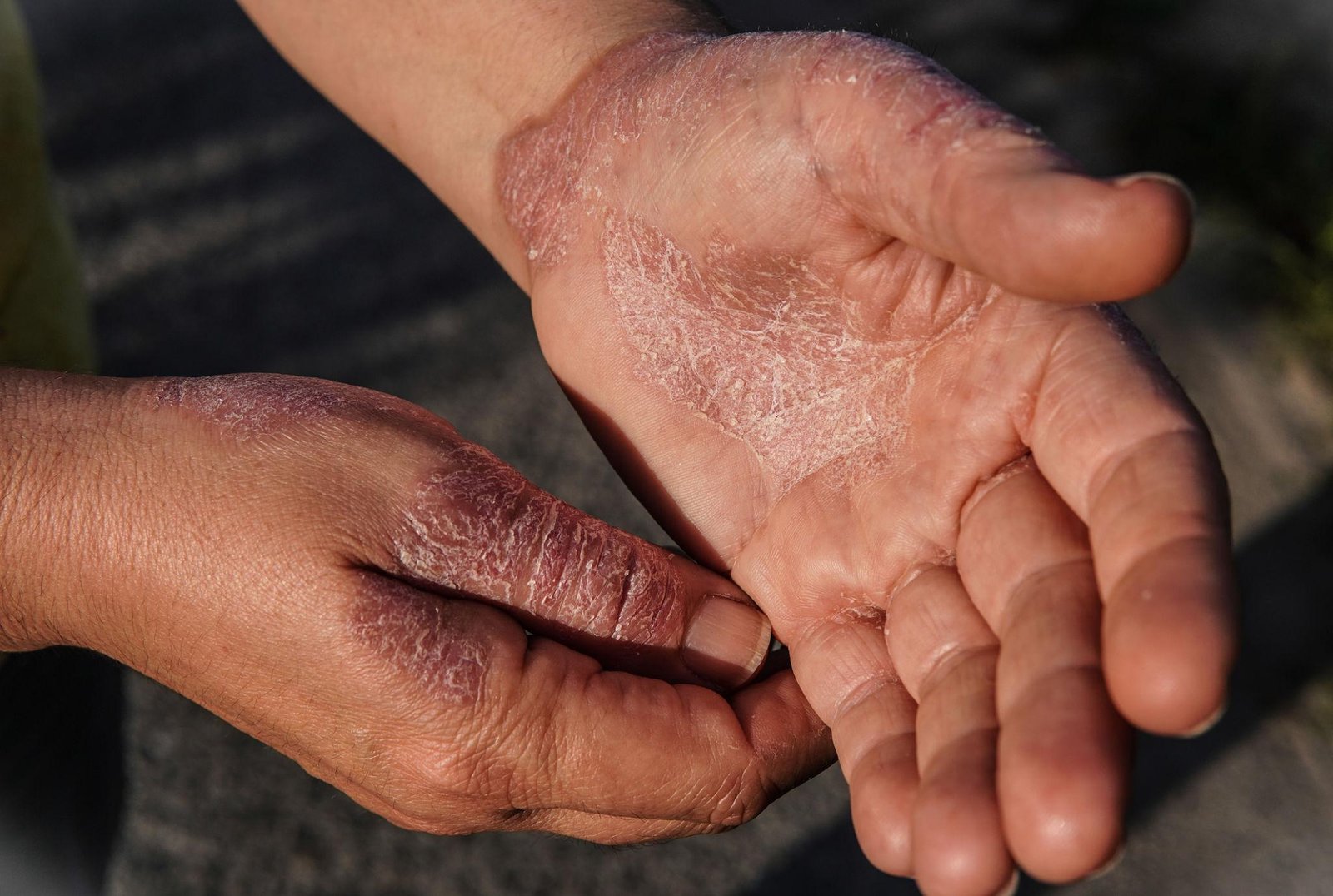 Eczema