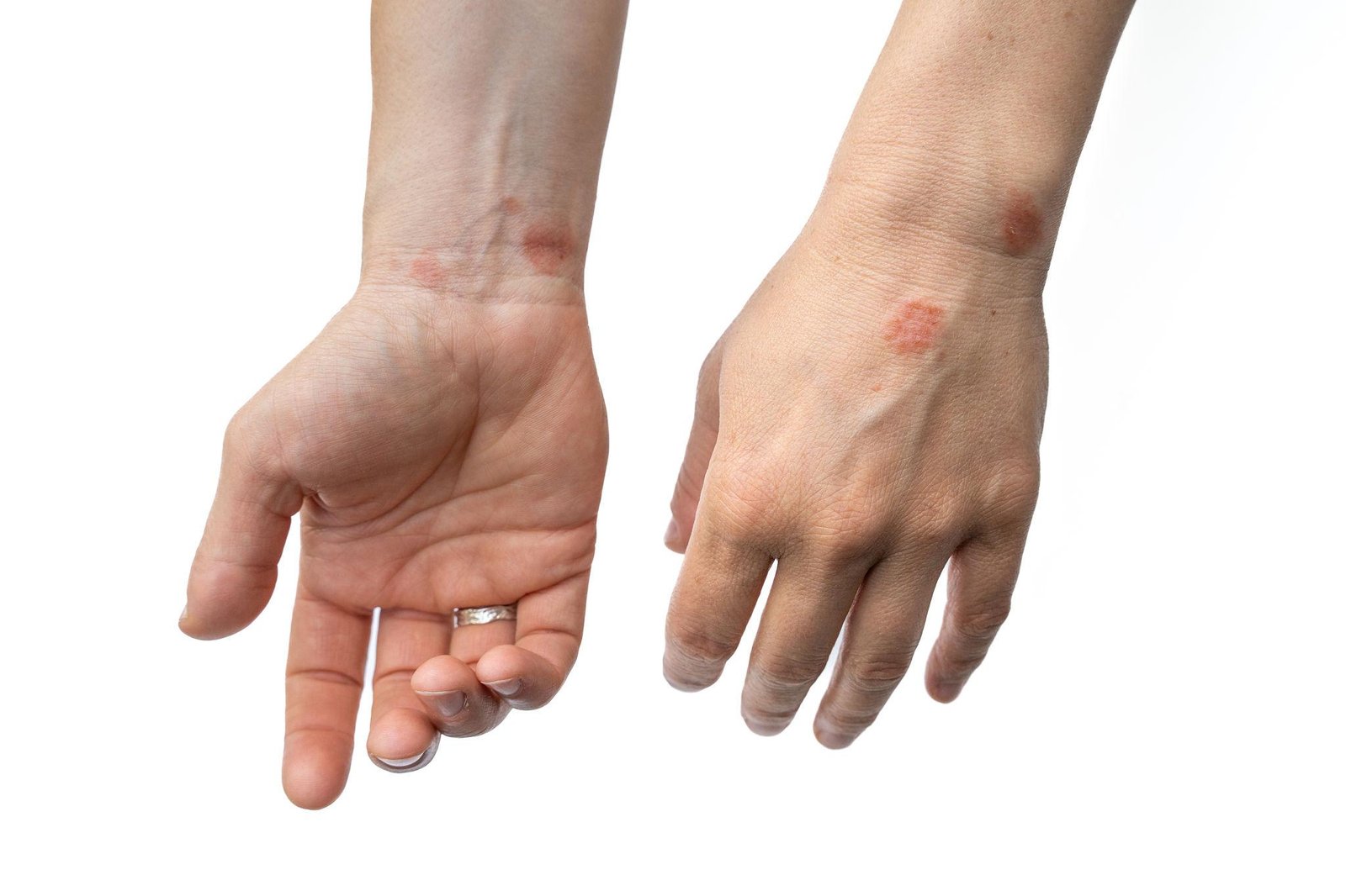 Dermatitis