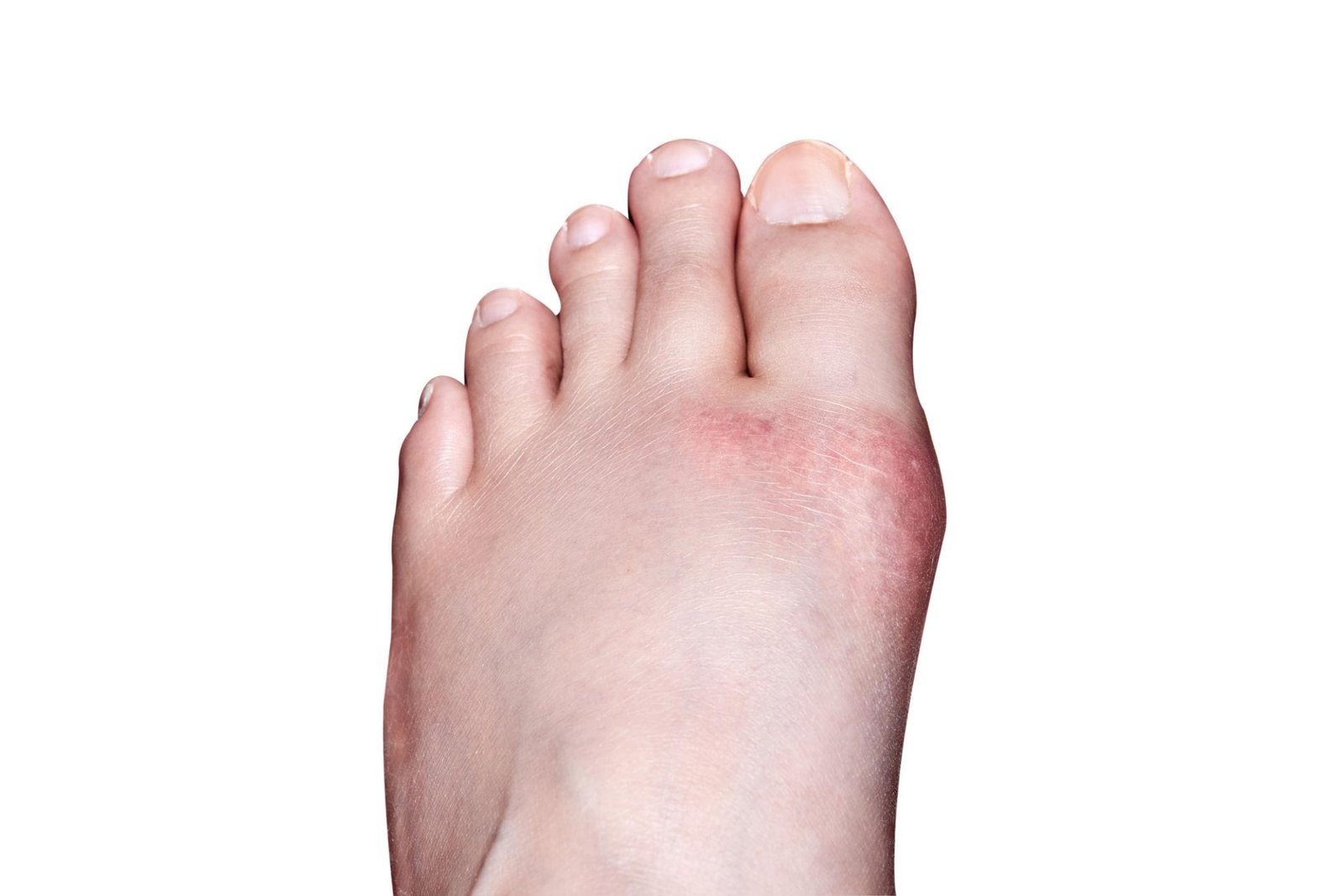 Gout