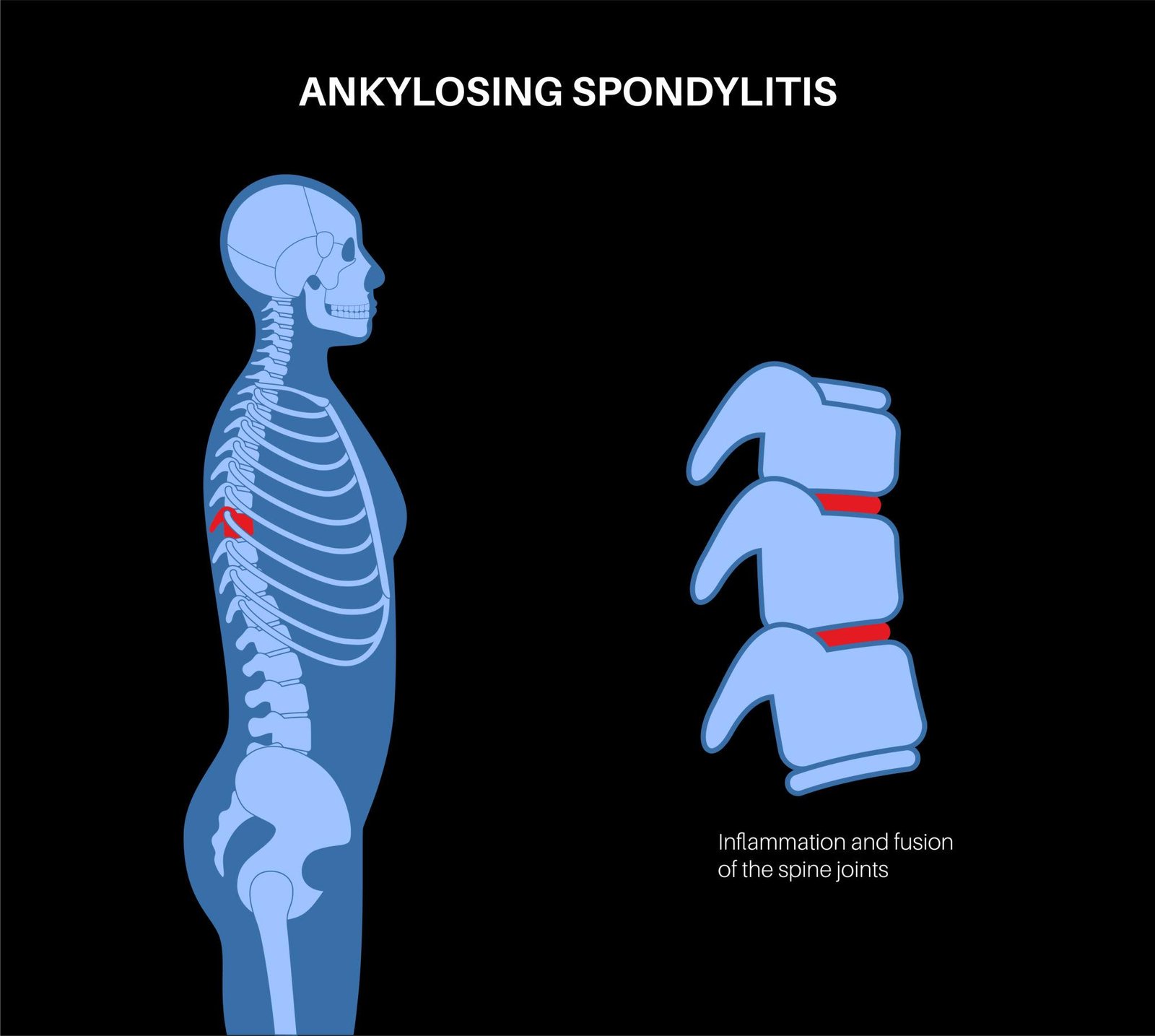 Ankylosing Spondylitis