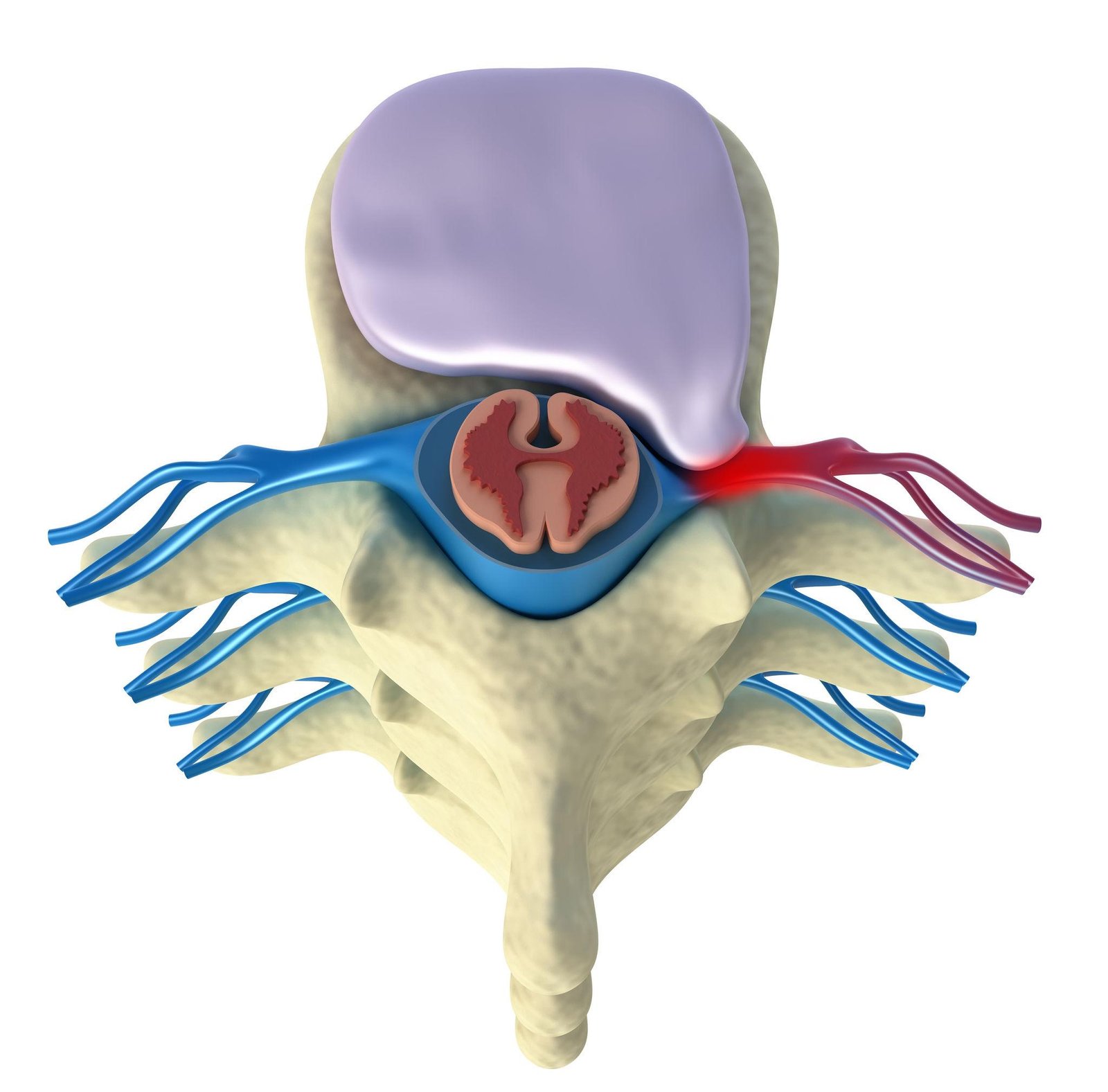 Herniated Disc