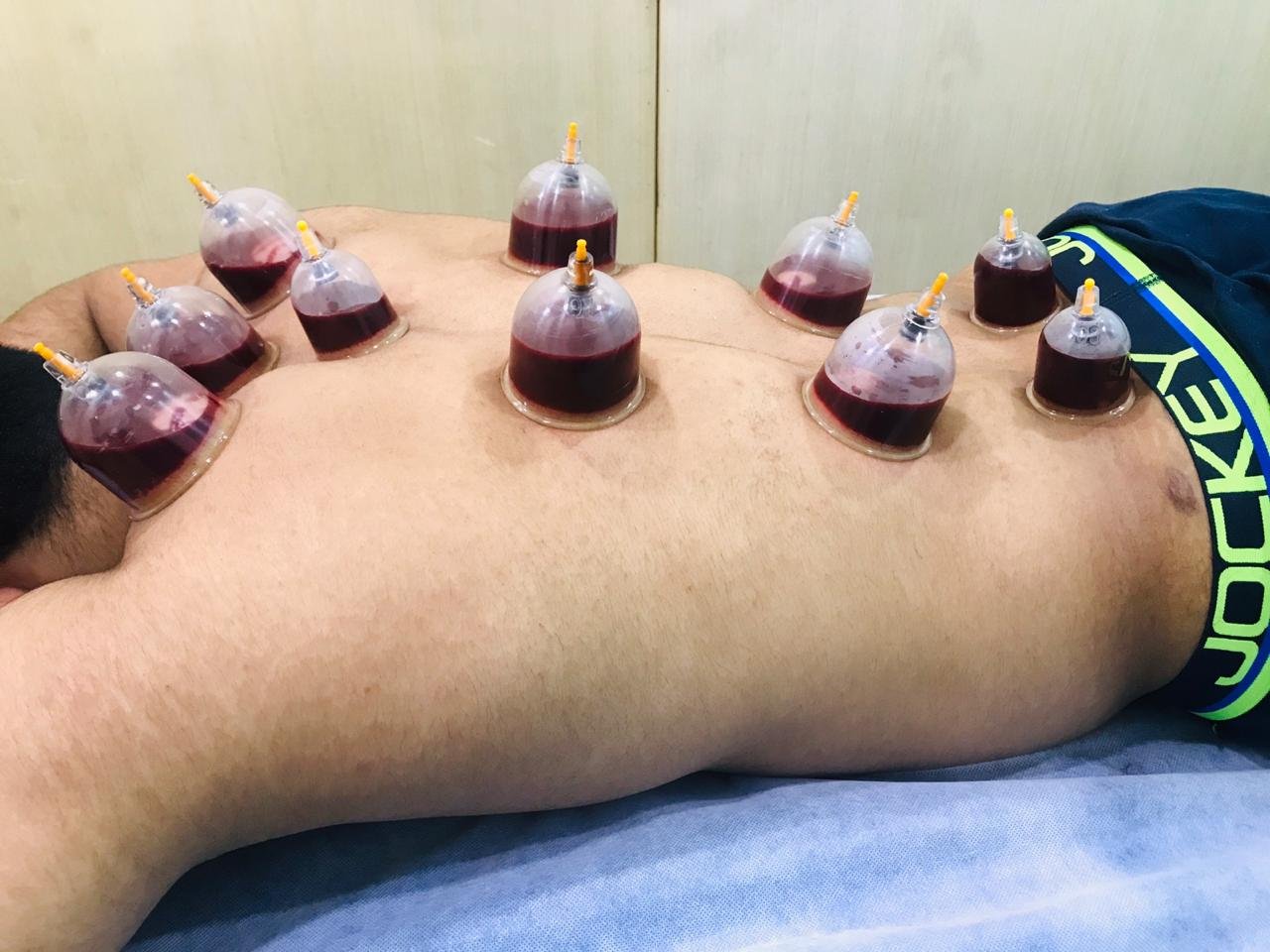 Wet Cupping / Hijama