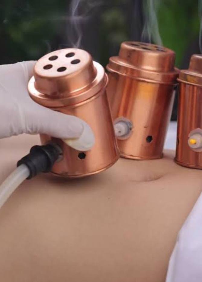 Moxa Cupping