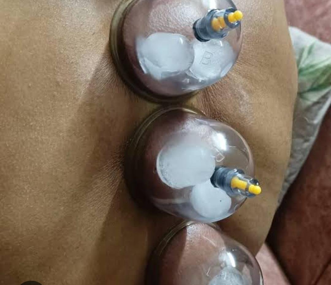 Ice Cupping