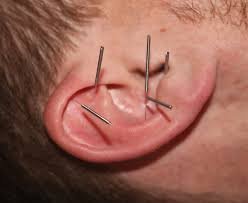 Ear Acupuncture