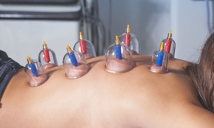 Magnet Cupping