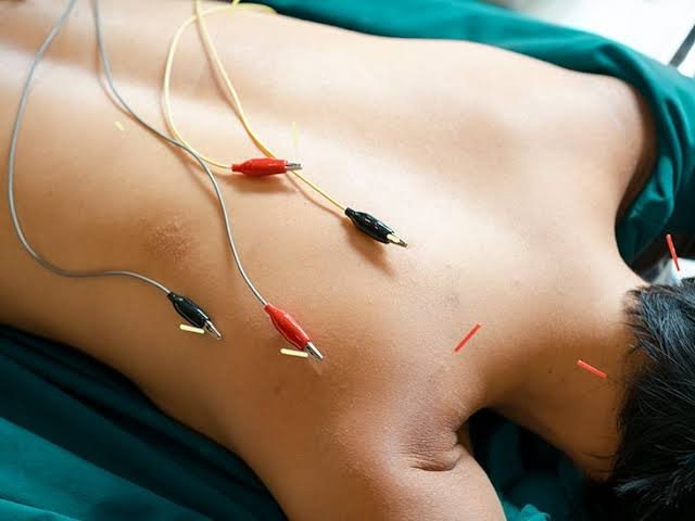 Acupuncture Stimulator