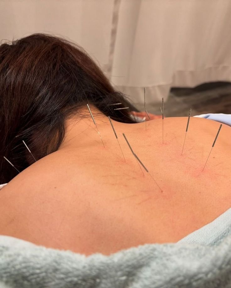 Acupuncture